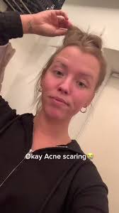 Oh daaamn didnt think my acne scaring was that bad! #fyp#foryoupage