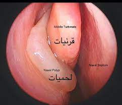 Multiple techniques have been described to prevent lateralization of the middle turbinate. Ø§Ù„ÙØ±Ù‚ Ø¨ÙŠÙ† Ù‚Ø±Ù†ÙŠØ© Ø§Ù„Ø§Ù†Ù ÙˆØ§Ù„Ù„Ø­Ù…ÙŠØ© Ø§Ù„Ù…Ø±Ø³Ø§Ù„