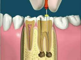 What Is Involved In Root Canal Treatment Dental Implants Cost Dental Hygiene School Dental Videos
