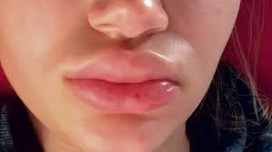 Image result for Angioedema