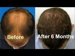 Peppermint oil is very beneficial if used properly. This One Oil Turns From Bald To Hair Growth In 6 Months Youtube