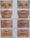 Injections d acide hyaluronique sur les rides du visage - Dr Picovski