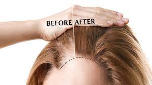 To practice champi at home pour some oil into a bowl and make it warm by keeping in hot water. Best Ayurvedic Treatments For Hair Growth Sureshot Ayurveda