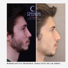 Dichiarate la lista degli oggetti di valore portati in turchia e fatela controllare all'entrata, al servizi telefonici per chiamare l'italia dalla turchia il prefisso è 0039 più il prefisso della singola città. Chirurgia Platica In Turchia Una Soluzione Che Fa Invidia A Tutto Il Mondo City Roma News