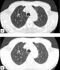 Deux séries d'images sont toujours réalisées, les unes sans injection de produit de contraste puis avec injection. Scanner Thoracique Ultra Basse Dose La Mort De La Radiographie Thoracique Sciencedirect