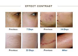 Maybe you would like to learn more about one of these? 40w Co2 Fractional Laser Skin Tightening Scar Removal Beauty Machine Ce Approved Co2 Vaginal Laser Therapy Beauty Machine Buy Co2 Fractional Laser Scar Removal Laser Skin Tightening Scar Removal Co2 Vaginal Laser Therapy