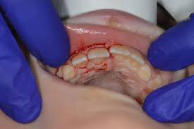 Image result for Tooth Luxation