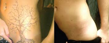 Oh and did i mention less painful? The Profitable Economics Of The Tattoo Removal Industry