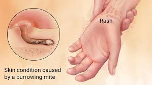 Image result for Scabies
