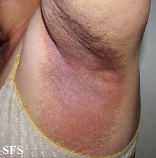 Image result for Erythrasma