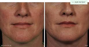 The chemical used for deep chemical peels is phenol acid. Chemical Peel Aesthetic Solutions