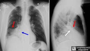 Image result for Atelectasis