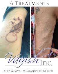 Laser tattoo removal before & after photos tattoos are extremely common ornamentation on american skin. Tattoo Removal Before And After Tattoo Removal Tattoos Laser Tattoo Removal