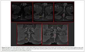 Magnetic Resonance Imaging in Assessment of Anorectal Fistulae and its Role  in Management | OMICS International