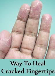 Is there a name for chronic, painless wrinkling that progresses to peeling (without any blistering) in one single location? How To Heal Cracked Fingertips Remedies For Cracked Fingertips Gilscosmo Com Shopping Made Ea Cracked Fingertips Peeling Fingertips Skin Peeling On Hands