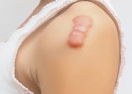 Image result for Keloid