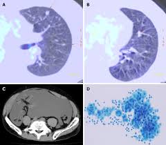 This type of cancer forms in the cells that give color to your skin, called melanocytes. In Vitro Proliferation Assay With Recycled Ascitic Cancer Cells In Malignant Pleural Mesothelioma A Case Report