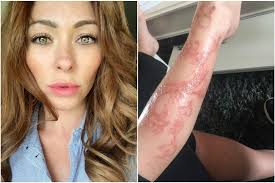 Teen Gets Temporary 9 Mike Tyson Tattoo On His Face Burns Leave Him With Embarrassing Scar Mirror Online
