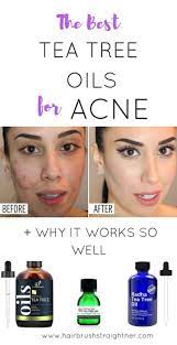 Best Tea Tree Oil For Acne Of 2021 Does It Work My Reviews Tea Tree Oil For Acne Best Tea Tree Oil Tea Tree Oil Benefits