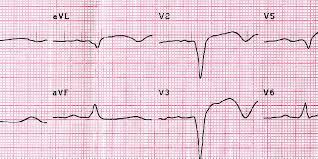 Nálezy ekg spojené s plicní embolií mohou naznačovat horší prognózu, protože šest nálezů identifikovaných s kmenem rv na ekg (srdeční frekvence> 100 úderů za minutu, s1q3t3. Infarkt Myokardu Diagnoza Nzip