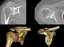 Image result for Shoulder Imaging