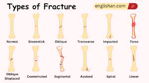 Image result for Fracture Types