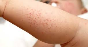 El principal tratamiento para la culebrilla es el uso de antivirales como el aciclovir, famciclovir, y/o valaciclovir. Es Contagiosa La Culebrilla Lo Que Necesitas Saber