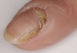 Brown spot on the cuticle. Hangnail Infected Hangnail Causes Symptoms Diagnosis Treatment