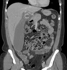 Zit er nog genoeg positieve interactie in jullie relatie? Appendicitis Wikipedia