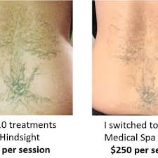 Free consultation with vernon hills, north shore and chicago tattoo removal. Hindsight Tattoo Removal 26 Photos 82 Reviews Tattoo Removal 1062 N Milwaukee Ave Chicago Il Phone Number