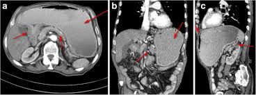 Attaches itself to the tissue under the skin in that area; Diagnosis Of Gastric Cancer By Mdct Gastrography Diagnostic Characteristics And Management Potential Egyptian Journal Of Radiology And Nuclear Medicine Full Text