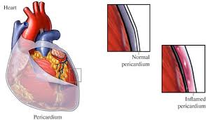 Image result for Pericarditis