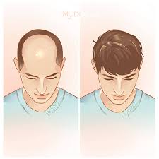 Klinik putramedic kuantan 24 jam (cawangan kurnia batu 3). Best Hair Loss Treatment In Kuantan Price Guide Reviews