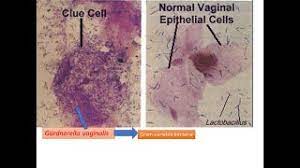 You can download latest version from github. Bacterial Vaginosis Introduction Clue Cell Significance And Amsel Criteria