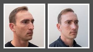 𝑹𝒉𝒊𝒏𝒐𝒑𝒍𝒂𝒔𝒕𝒚 𝑻𝒓𝒂𝒏𝒔𝒇𝒐𝒓𝒎𝒂𝒕𝒊𝒐𝒏 Our out-of-town patient  was kind enough to share his own before and after photos with us. When he  was younger, he was hit in the nose with a baseball and