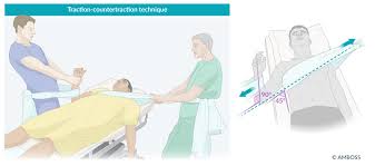Image result for Shoulder Relocation Maneuvers