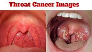 Throat cancer occurs when cells in your throat develop genetic mutations. Hpv Throat Cancer Blogs Hpv Throat Cancer Blog Hpv Throat Tumor