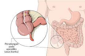 Banyak wanita hamil yang mengira sakit pada perut yang dirasakan merupakan pengaruh dari kehamilannya. Penyakit Usus Buntu Gejala Penyebab Dan Mengobati Alodokter
