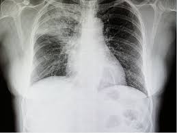 Image result for lung cancer xray