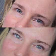 What are the best shields or rods for someone with hooded eyes and small  space between brows and eyes?