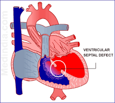 Image result for Ventricular Septal Defect