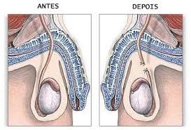 ¿qué sucede durante una vasectomía sin bisturí? Reversao De Vasectomia Medico Urologista