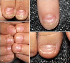 Image result for Beau lines feet