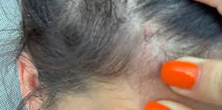 What type of skin cancer you have been diagnosed with. Pictures Skin Cancer On Scalp