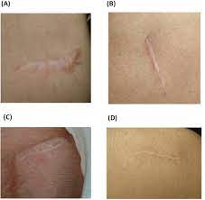 The only way to affect pacemaker function on an icd is with a programming device A Pilot Study Comparing Two Sites For Incision During Pacemaker Implantation And Their Influence On The Scar Sciencedirect