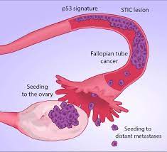 A raised level of ca125 can suggest either fallopian tube cancer or ovarian cancer. Scientists Track Ovarian Cancers To Site Of Origin Fallopian Tubes 10 23 2017