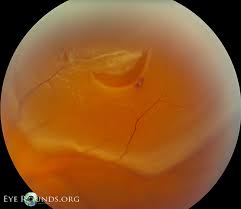 Check spelling or type a new query. Rhegmatogenous Retinal Detachment The University Of Iowa Ophthalmology