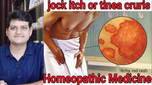 Jock Itch Fungal Infection Homeopathic Medicine For Tinea Cruris Explain Youtube