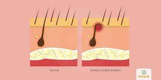 Rambut Tumbuh Ke Dalam Ingrown Hair Merupakan Rambut Yang Tumbuh Melengkung Dan Kembali Ke Kulit Cara Mengatasi Rambut Pisau Cukur Bintik Bintik Kulit Gelap