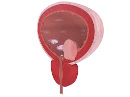 Image result for bladder cancer